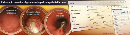 Listen to the podcast of 'Endoscopic resection of giant esophageal subepithelial lesions: experience from a large tertiary center' by Xiang et al. giejournal.org/content/podcast