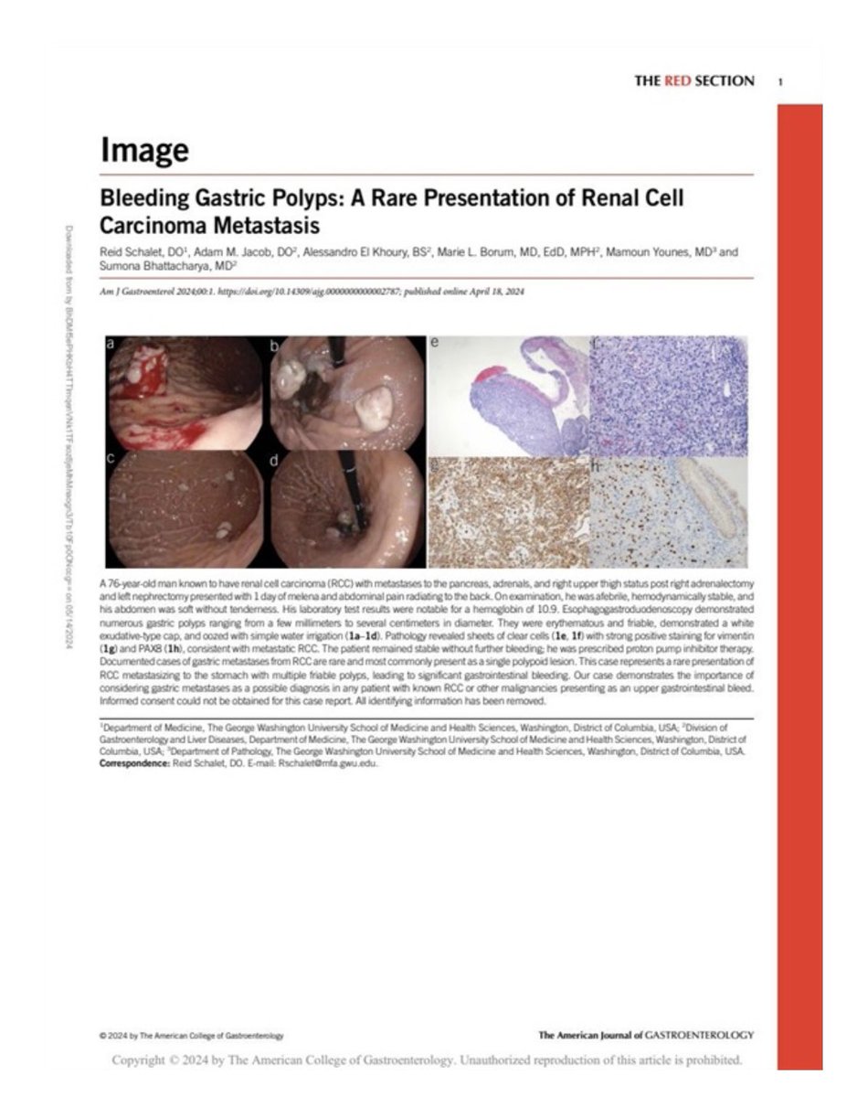 Some very unusual gastric polyps… great work <a href="/AdamMJacob/">Adam M. Jacob, DO</a> <a href="/SumonaB_MD/">Sumona Bhattacharya, MD</a> and co-authors! <a href="/AmCollegeGastro/">ACG</a> <a href="/GWHospital/">GWHospital</a> <a href="/GWSMHS/">GW SMHS</a> #GWIMRes <a href="/AmJGastro/">AJG - The American Journal of Gastroenterology</a>