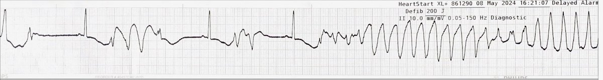 Recurrent syncope and fatigue