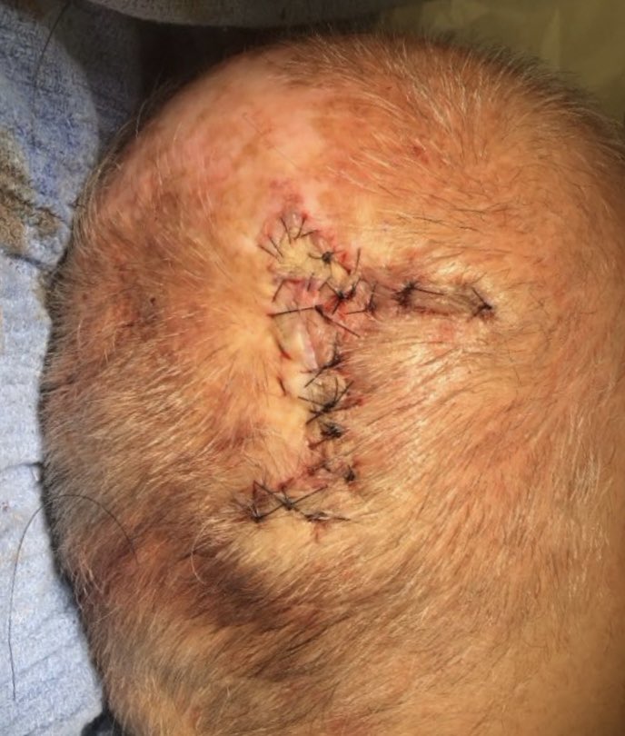 It’s very important to have routine skin checks by a board-certified dermatologist and if any skin cancers arise to have them treated appropriately. This was a Mohs micrographic surgery on an atypical fibroxanthoma on the scalp. This went three stages due to positive margins and