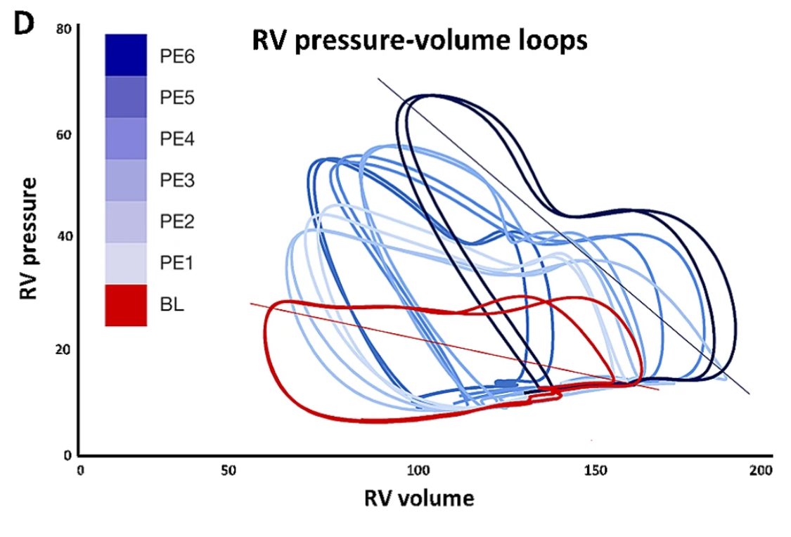 Mads Dam Lyhne (@madsdam_md) on Twitter photo What happens minutes after the acute #PE strikes? Cardiorespiratory parameters react differently to increased clot burden bmcpulmmed.biomedcentral.com/articles/10.11… #PVloops #peoplesventricle #hemodynamics🫀🫁🐷 <a href="/DocAsger/">Asger Andersen</a> <a href="/Jacob_G_Schultz/">Jacob Schultz</a> <a href="/Anders_K_H/">Anders Kramer</a> <a href="/CSMortensen/">Christian Mortensen</a> <a href="/Nielsen_Kudsk/">Jens Erik Nielsen-Kudsk</a> What happens minutes after the acute #PE strikes? Cardiorespiratory parameters react differently to increased clot burden bmcpulmmed.biomedcentral.com/articles/10.11… #PVloops #peoplesventricle #hemodynamics🫀🫁🐷 <a href="/DocAsger/">Asger Andersen</a> <a href="/Jacob_G_Schultz/">Jacob Schultz</a> <a href="/Anders_K_H/">Anders Kramer</a> <a href="/CSMortensen/">Christian Mortensen</a> <a href="/Nielsen_Kudsk/">Jens Erik Nielsen-Kudsk</a>