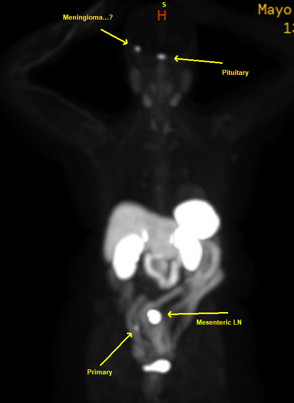 Today's SSTR PET image:

Take home messages:

1. Primary tumors are often much smaller than the metastatic lesions as in this case of a large mesenteric node (N2)

2. Not everything that lights up on SSTR PET is a NET. Meningiomas express SSTRs too (as do many other things...)