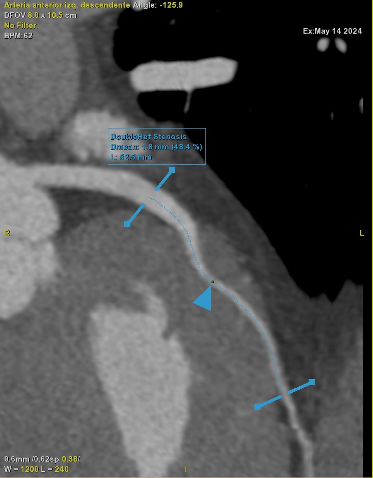 44 yo male with chest discomfort and ECG repolarization abnormalities… are myocardial bridges always a casual finding in CT? Pay attention if depth is more than 2 mm…
