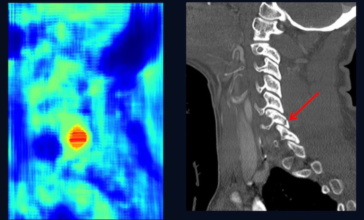 Study Finds High Concordance Between #AI and Radiologists for C-Spine Fractures on CT diagnosticimaging.com/view/study-hig… @ACRRFS @ACRYPS @RadiologyACR @ARRS_Radiology @RSNA @The_ASSR @RadiologyUSC @StanfordRad @RadiologyUcla @UCSFimaging @OHSURadiology #radiology #RadRes #CTRad #ARRS24