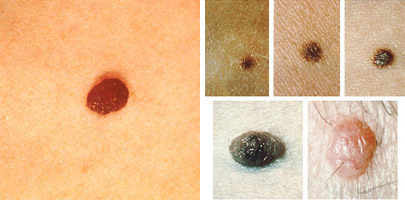 May is Skin Cancer Prevention Month, so we wanted to remind you of the ABCDEs of skin cancer detection. From asymmetry to evolving spots, knowing what to look for could save your life. Read this blog to learn the ABCDEs and other warning signs. bit.ly/3UxNdGw