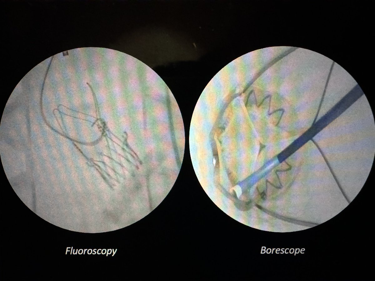 💥 It’s 3am, my STEMI pt has a TAVI 😱 Don’t worry 😇 join us for: 💡Tips & Tricks on Coronary Access 💡Insights from real Cases 💡Hands-on simulation training Practice makes Perfect #simulation #EuroPCR @AlexWol76944346 @PCRonline