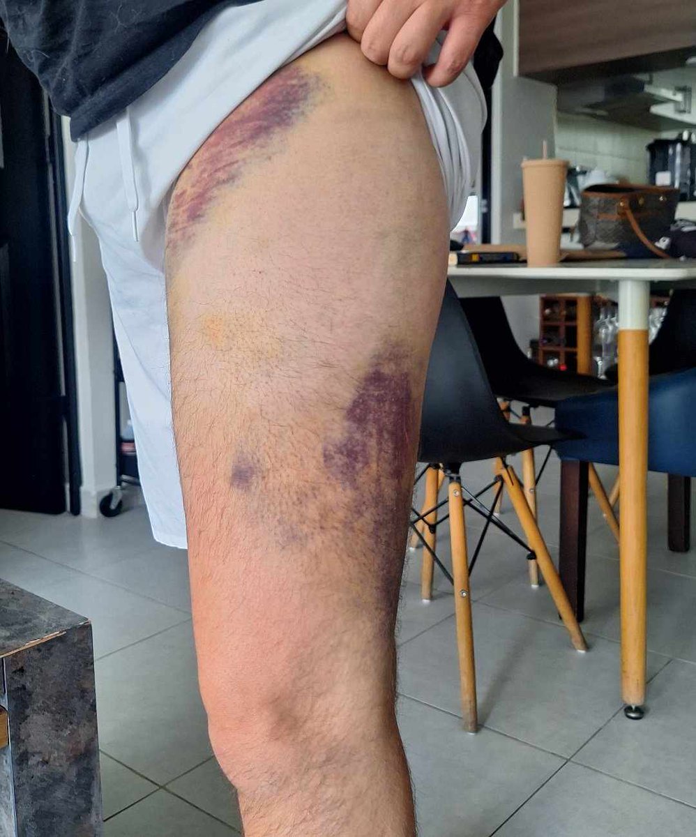 mickeymh_87's tweet image. EN IG / EN C4
Adrian Shamir Aguado 
El Pechugas
En 2018 la @FiscaliaCDMX lo ligaba con asesinatos, drogas y compraventa de ropa pirata…
Operaba en La Arenal, La Pantitlan…
Huyó a Morelos, pero allá lo encarcelaron.
Así se lucia en redes
Así acabó. 
#C4Jimenez