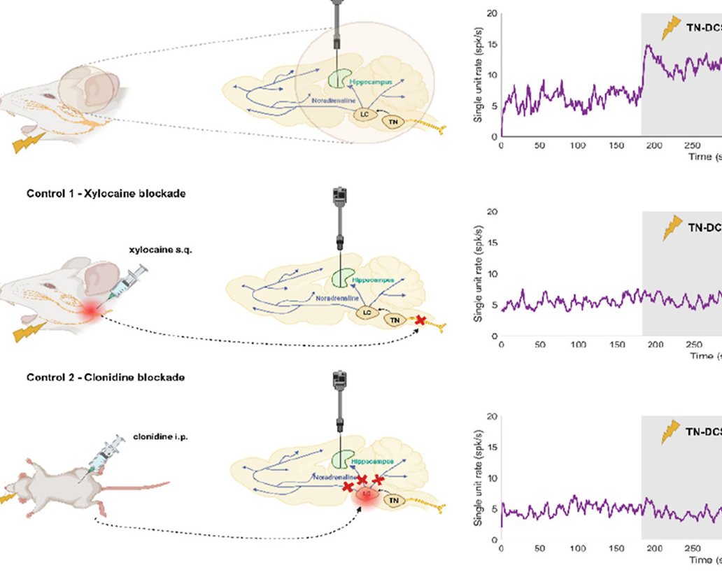 Liyi Chen et al. demonstrate that direct current stimulation targeting the trigeminal nerve has a sustained effect on hippocampal firing rate. brainstimjrnl.com/article/S1935-…