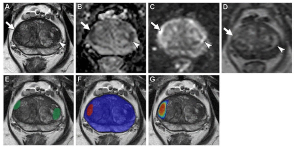 . #MRI Based #DeepLearning Algorithm Shows Comparable Detection of csPCa to Radiologists diagnosticimaging.com/view/mri-based… @ACRRFS @ACRYPS @RadiologyACR @ARRS_Radiology @RSNA @SocietyAbdRad @DukeRadiology @PennRadiology @WCMRadiology @UVARadiology @UABRadiology #radiology #RadRes