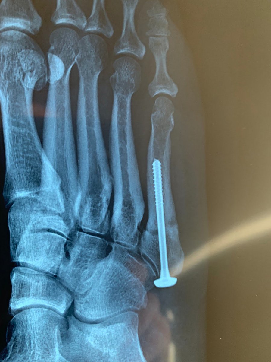 Johnny Newton #NFL A Jones fracture is a fracture to the base of the pinky bone in the foot. This area is known as a ‘watershed’ area that has a very poor blood supply and doesn’t heal well. These are relatively common, and usually do really well with surgery, which often