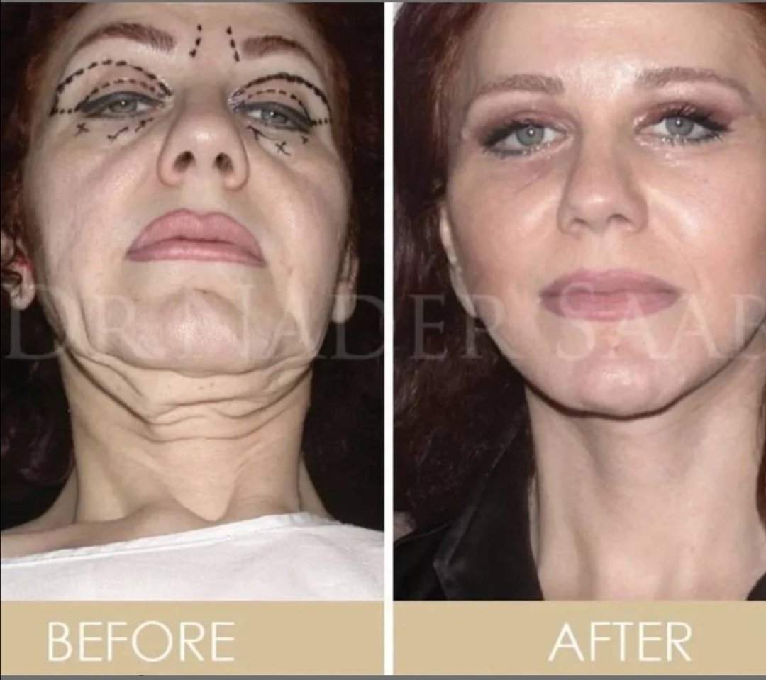 تفضلوا هاي الحناوي قبل وبعد