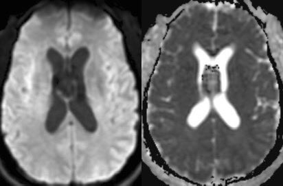 What is the most likely diagnosis in this 50 y/o patient presenting w/ acute onset headache, nausea and vomiting? 🧠 

#neurosurgery #Neurology #radres #futreradres #medicine #meded #FOAM #ENT #ophthalmology