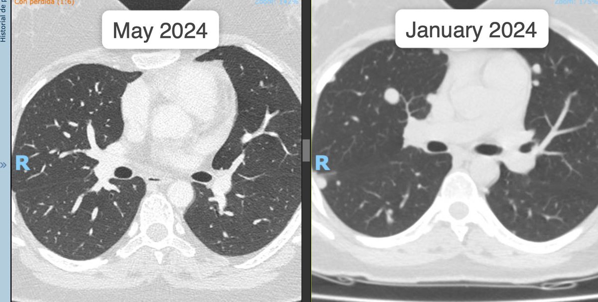 I have no conflicts of interest, just a pure passion for sharing: Axitinib's efficacy in treating Pulmonary Metastatic Renal Cell Carcinoma is remarkable. 
Only 4 months between each CT scan! Those little moments in my daily work bring me happiness ☺️ 😀 #axitinib #oncorad