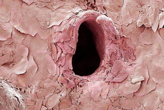 This is the hole in your skin after a needle punctures it, as seen from a scanning electron microscope (SEM)