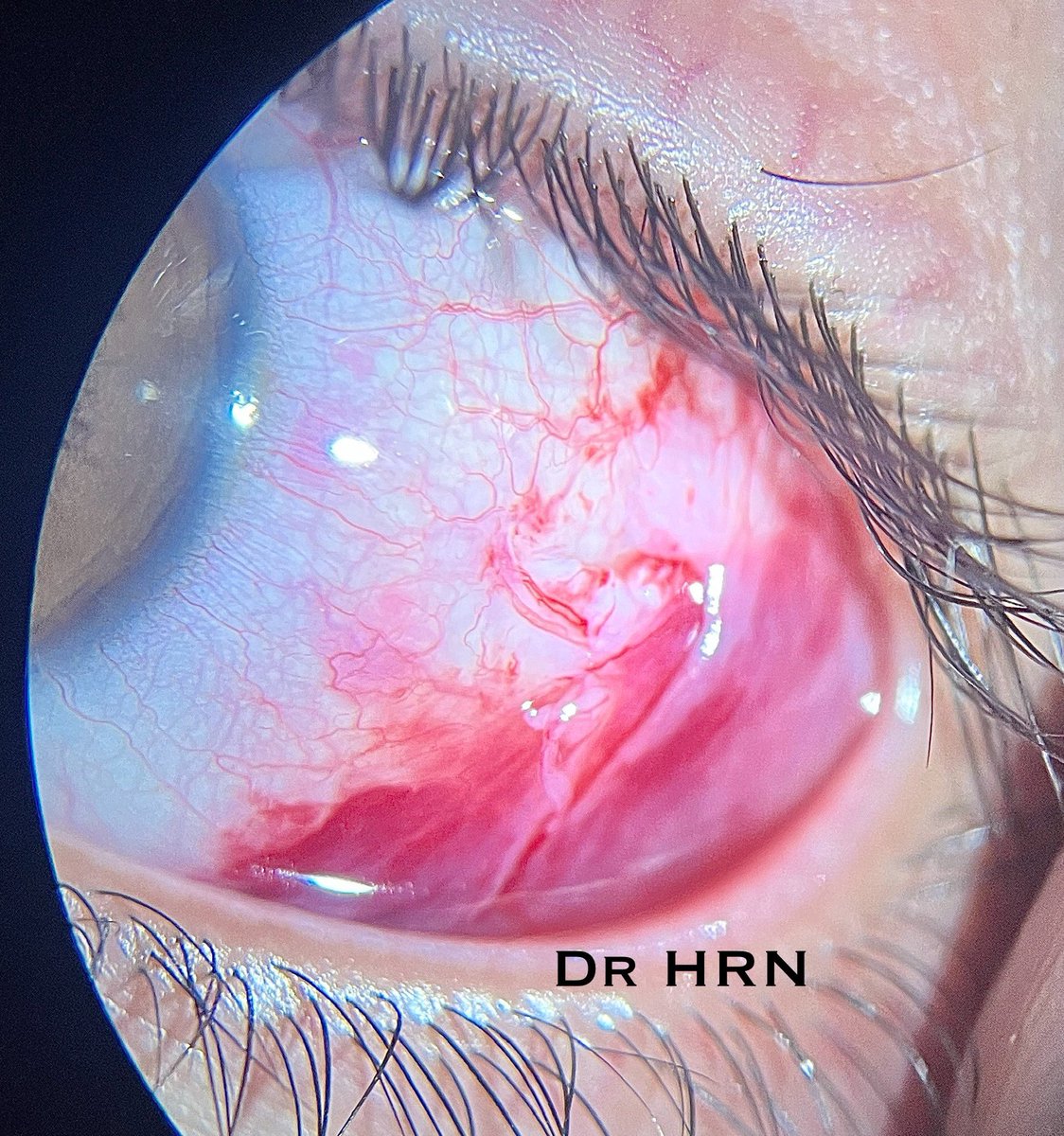 Conjunctival Tear in a child by an over friendly family cat when he was sleeping. 
I am sure the cat meant no harm. But #catlovers , you need to trim those nails. 

#Ophthalmology #OphthoTwitter #MedTwitter #PatientCare