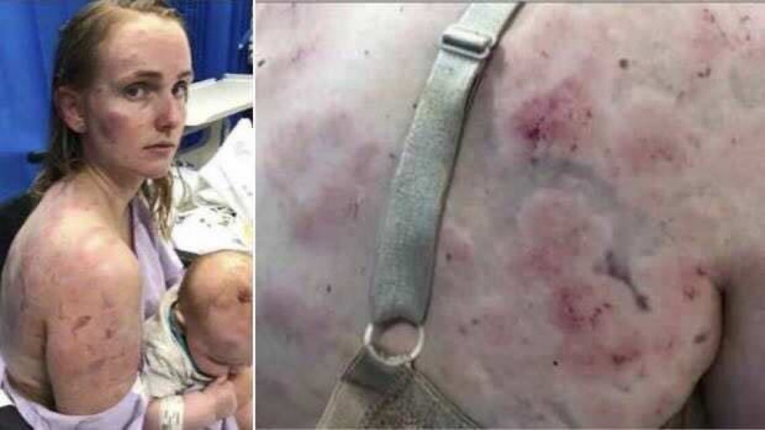 VichVideo's tweet photo. Australian mother uses her body to protect baby during a hail storm https://t.co/BespwWDZeX