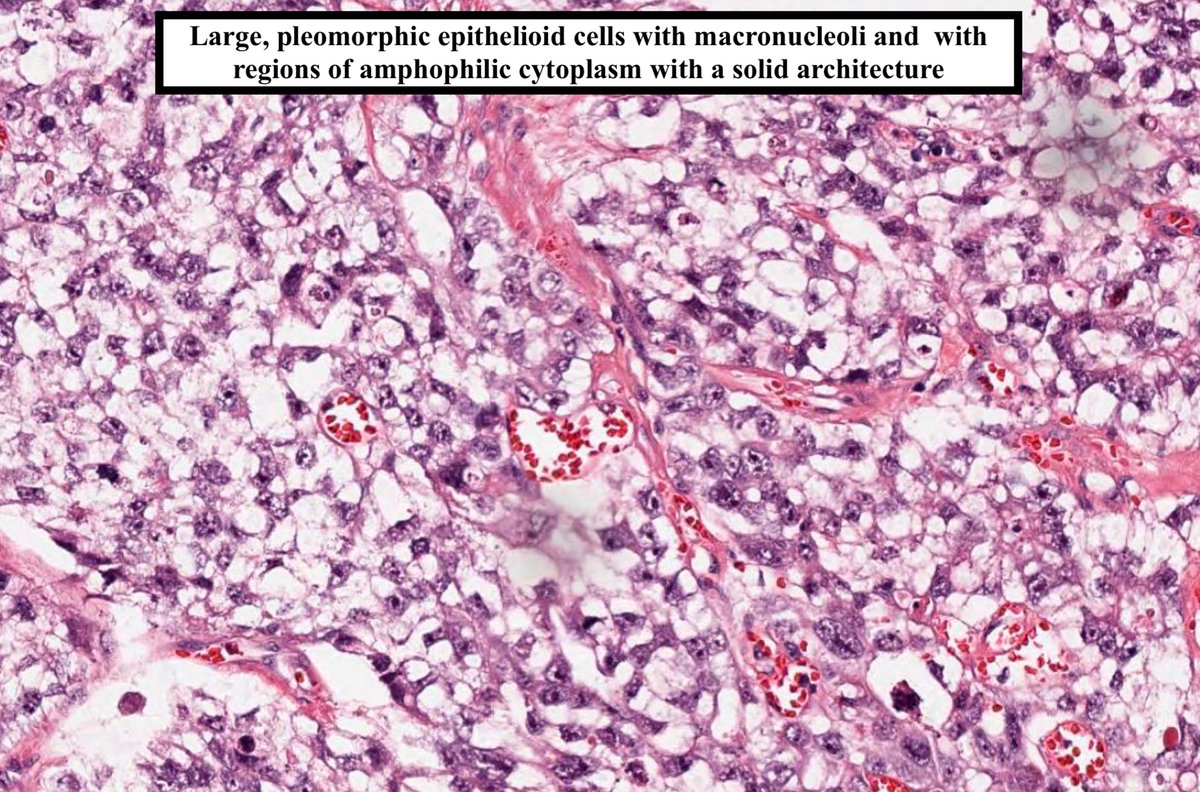 Embryonal Carcinoma

• #2 most prevalent testicular germ cell tumor (after seminoma)

• Peak incidence is 30 y/o (10 years younger than seminoma)

• Most common element seen in mixed germ cell tumor.  

• IHC: CD30 and AE1/AE3 + 

Image Credit: Kelly Hall, MD

#pathagonia
