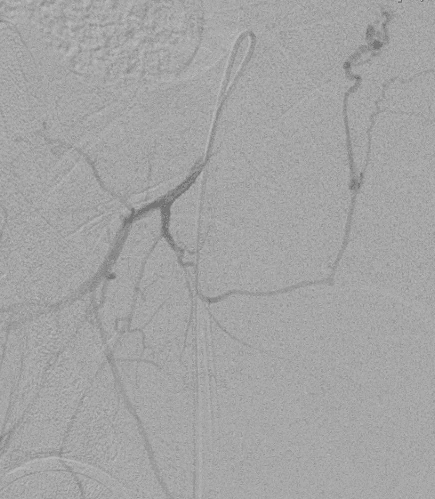 "Always a joy to save lives, even at 4 AM after a long day 😅. In a small hospital in Spain, we have 24/7 interventional radiology services. Amazing! Meanwhile, in the UK, nearly 50% of hospitals struggle with urgent obstetric hemorrhage emergencies. Time for a change!