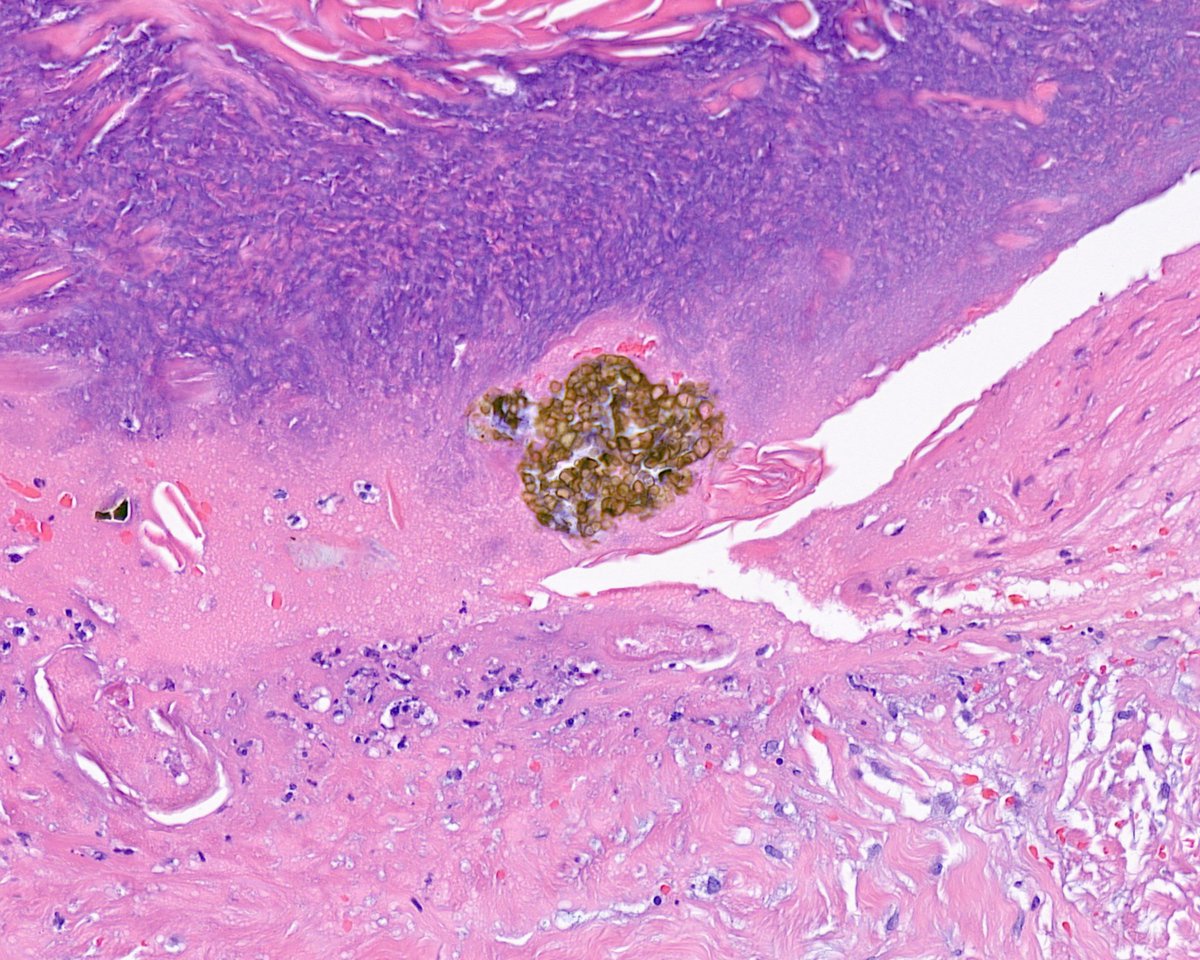 Reexcision of melanoma with a pigmented surprise