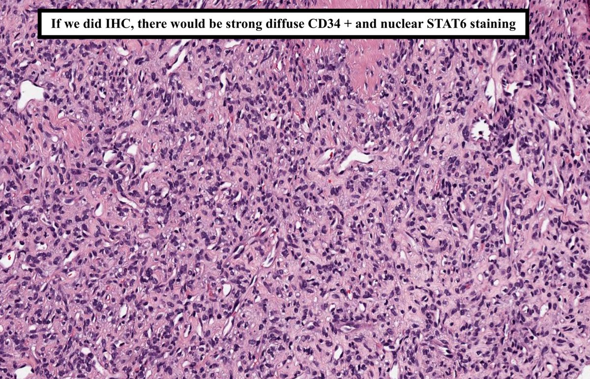 Solitary fibrous tumor (SFT)

•  Fibroblastic tumor; can occur anywhere in body 
(superficial +deep soft tissue, bone, visceral organs, CNS, salivary gland)

• Peak incidence:40-70 y/o; may undergo mets

• Molecular: NAB2-STAT6 fusion 

Image credit: Kelly Hall, MD
#pathagonia