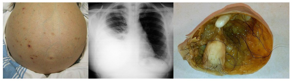 The findings from a 36-year-old woman with cough, breathlessness, and abdominal fullness are shown, what is the most appropriate diagnosis?