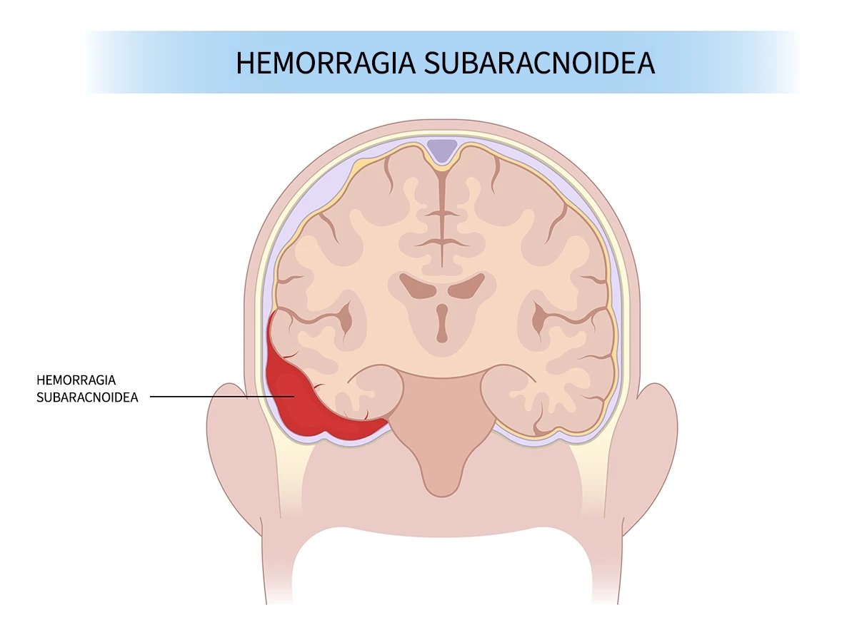HEMORRAGIA SUBARACNOIDEA Se trata de un sangrado en el espacio subaracnoideo, donde sólo circula líquido cefalorraquideo normalmente. La causa más frecuente de este tipo de hemorragias cerebrales es en primer lugar los trauma... tumedicoaltelefono.es/hemorragia-sub… es.aurorahealthcare.org/services/neuro…