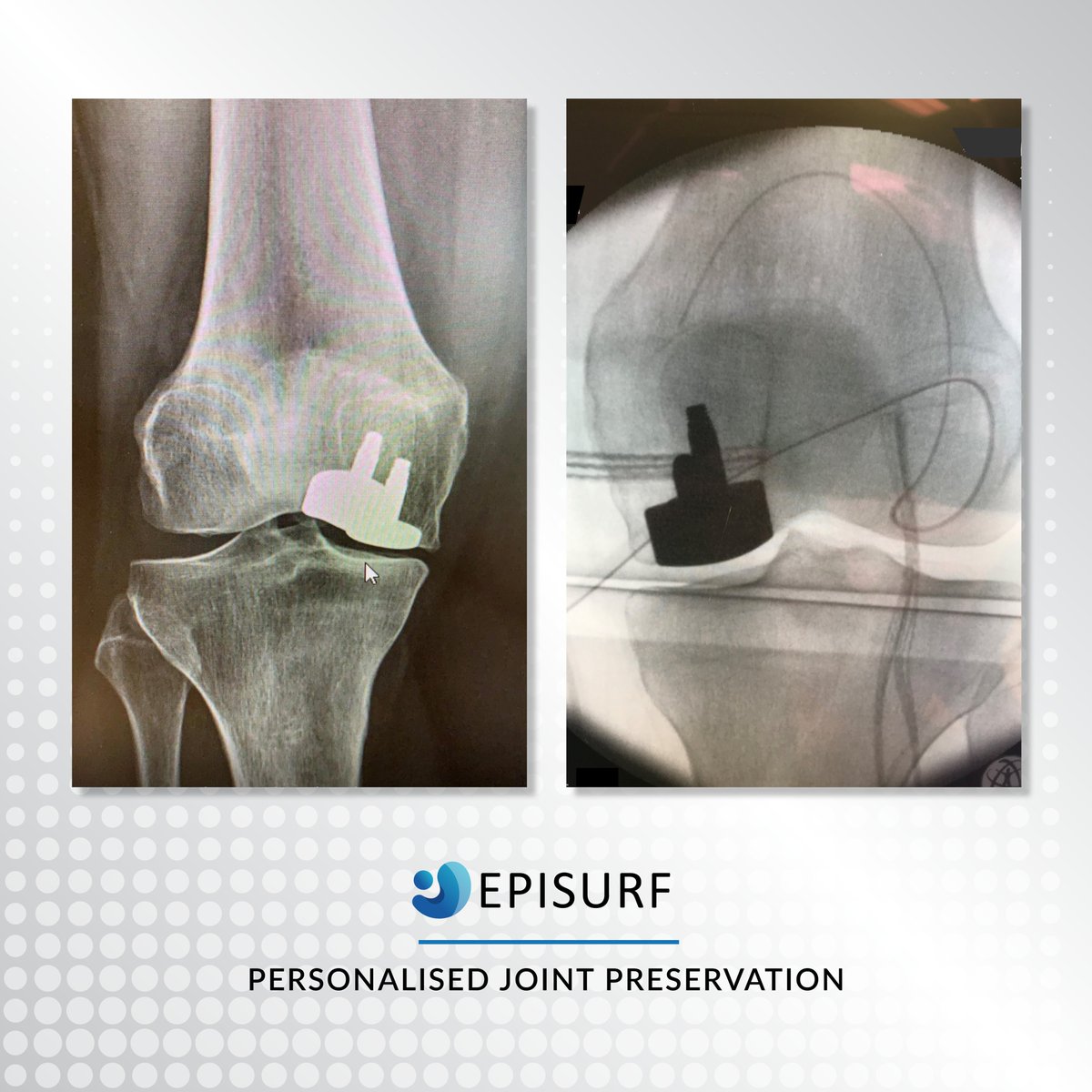All knees are different! We personalise each Episealer® implant to match the patient's anatomy, restoring the knee joint kinematics. #kneepain #Episealer #cartilage #resurfacing #orthopaedics #orthotwitter