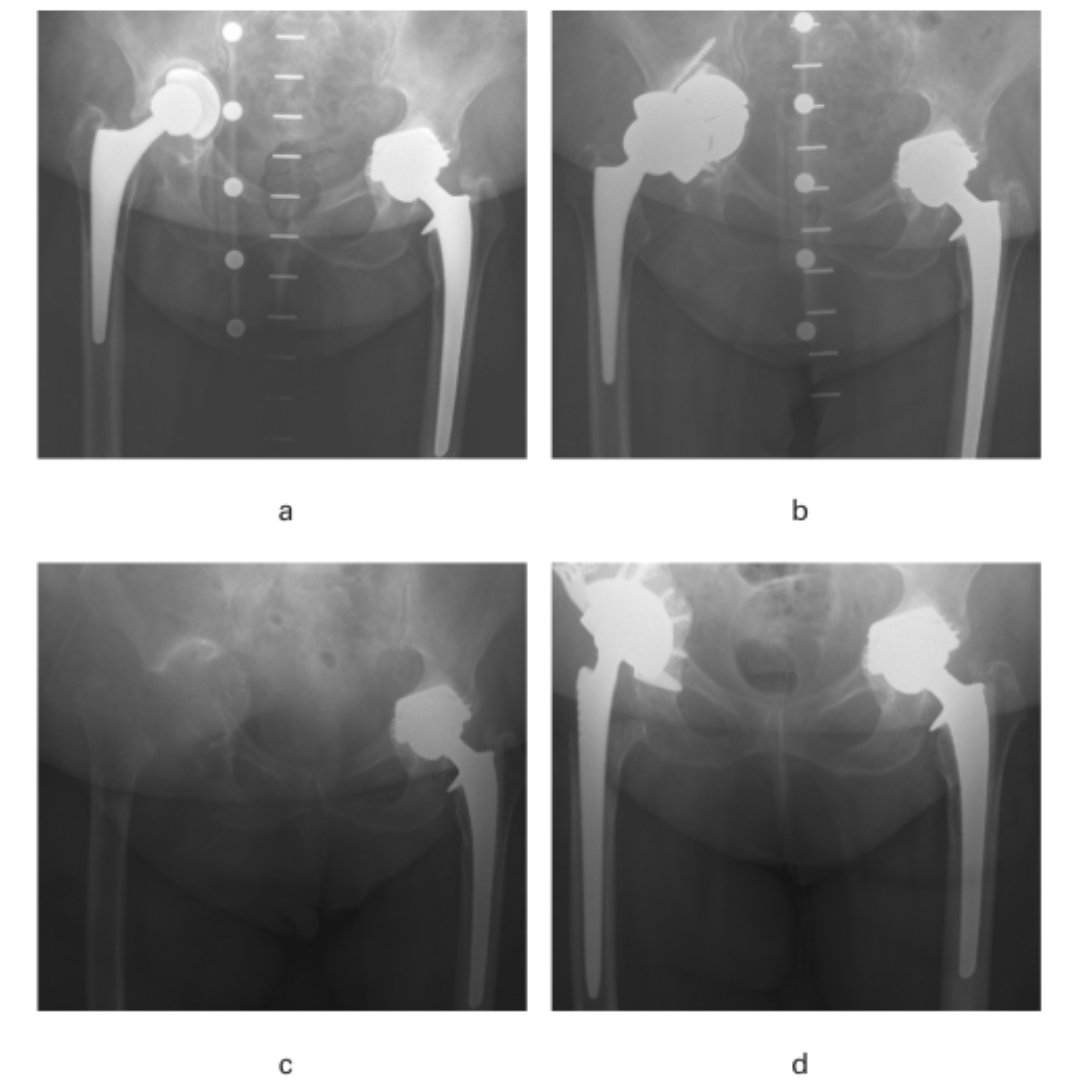 Recent studies have published promising results using porous metal components in acetabular defects, but none have analyzed the management of Paprosky IIIB defects with trabecular metal components using the footing technique. #BJJ #Hip #Arthroplasty ow.ly/Ofuf50RuKp0