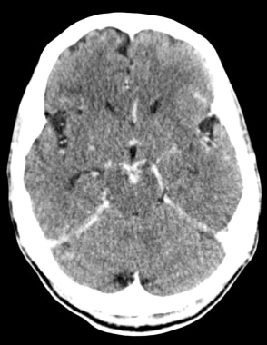 A 🧵 on recommendations on steroid therapy First a question ❓️ 45 Yr male diagnosed with Tuberculous Meningitis was started on antitubercular drugs and 60mg presnisolone daily. How do you plan to taper and stop steroids❓️ #MedTwitter #MedEd #MedX #steroid