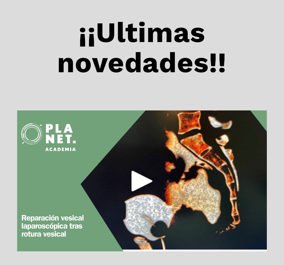 ¿Quieres ver como reparar una fístula vesical yatrogénica? Visita planetacademia.com para ver nuestro último video y recuerda suscribirte! @ResidentesCAU @ResidentesAEU @InfoAeu @CAU_URO @uromadrid