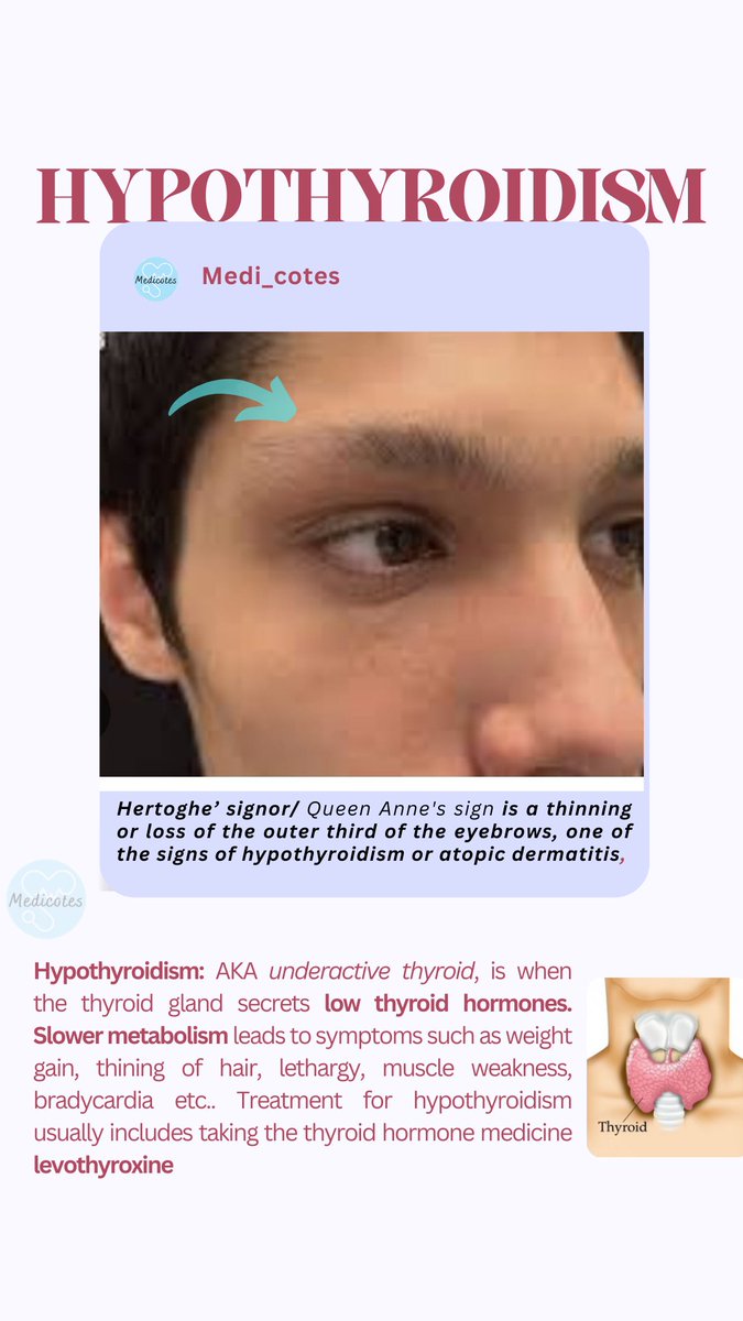 Hertoghe's sign= one of the physical sign of hypothyroidism 

  #medicine #medi_cotes #meded #MedicalMCQs #medtwitter #medx #questformedicine #medicalnotes #NCLEX #physicianassociate #usmleprep #hypothyroidism #hertoghesign #thyroiddisease #questformedicine #endocrinology