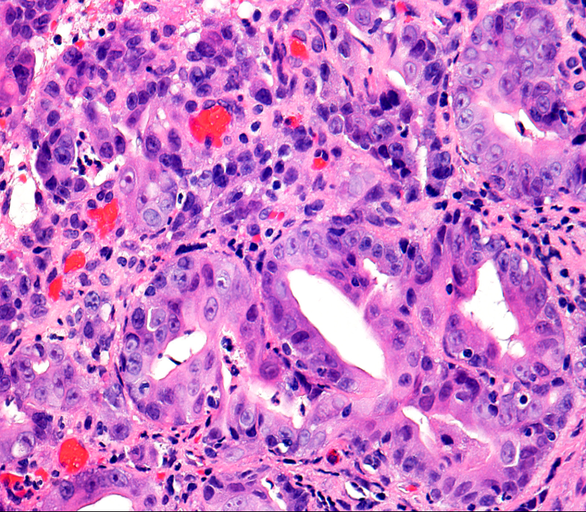 Anarkhuu's tweet photo. Stomach biopsy, what is your diagnosis? #GIpath https://t.co/CXx3nsHHOt