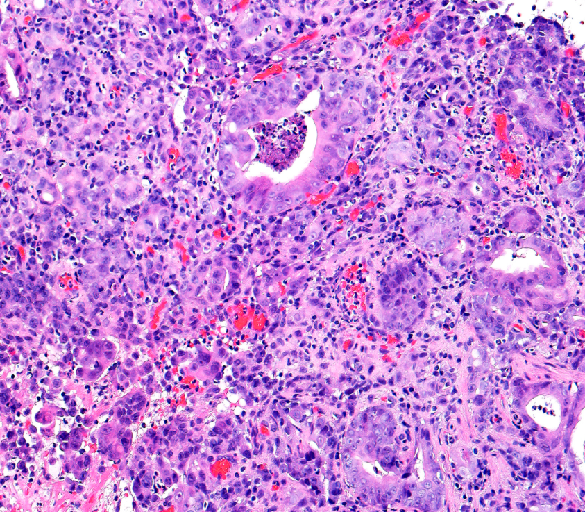 Anarkhuu's tweet photo. Stomach biopsy, what is your diagnosis? #GIpath https://t.co/CXx3nsHHOt