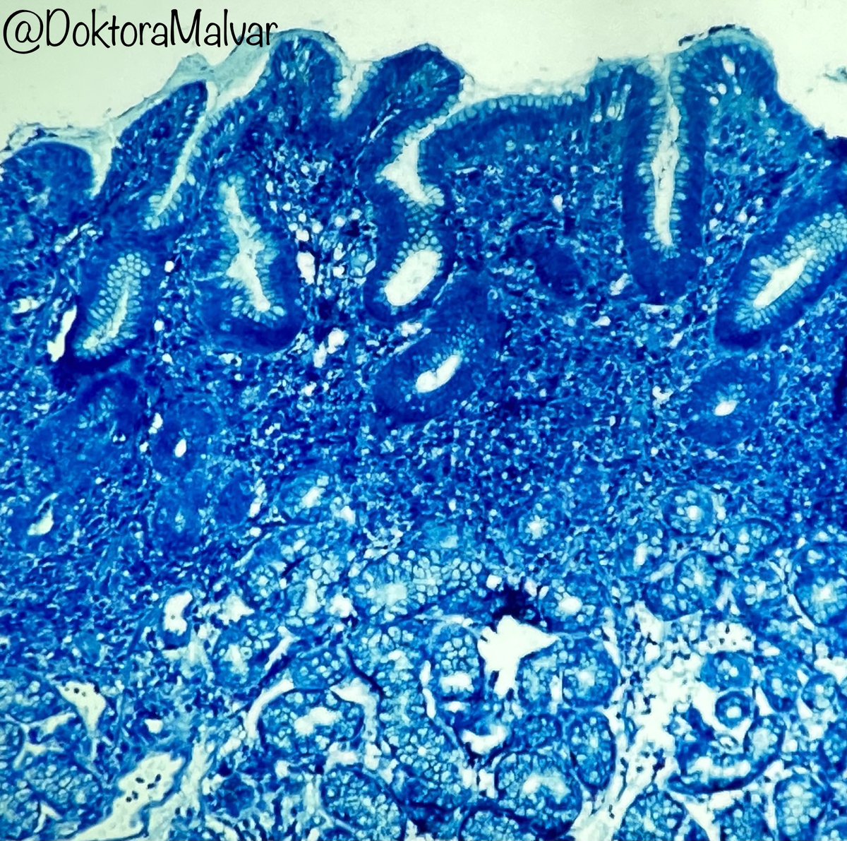 Grace L. Malvar, MD (@doktoramalvar) on Twitter photo Giemsa stain glamour shots of Helicobacter helmanii party (looks like cavatappi pasta!) #GIpath #pathoutpic Giemsa stain glamour shots of Helicobacter helmanii party (looks like cavatappi pasta!) #GIpath #pathoutpic