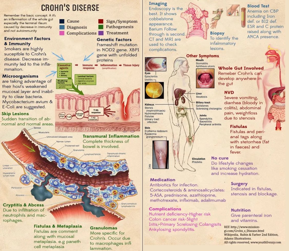 Crohn's Disease - Summary

#medtwitter #foamed #meded