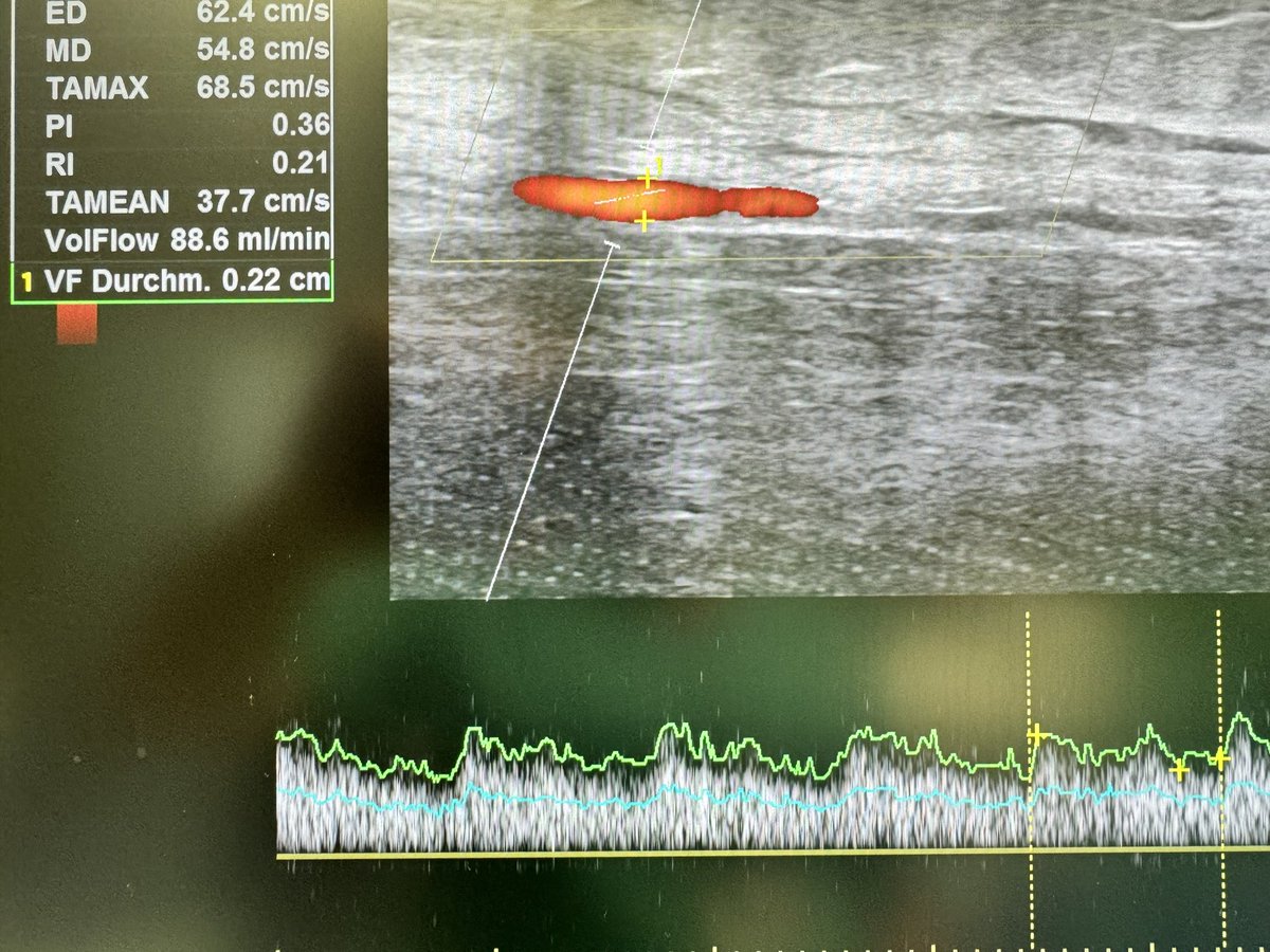 robshahverdyan's tweet photo. ⚠️🚨 Access folks: you create a radiocephalic AVF in a young female patient with #APKD and #ESKD. Assuming you measure the intraoperative volume flow (which IMO you should do as we do every time in Hamburg), and see this: Qa 490ml/min, 5 minutes later 88ml/min. What would you do? https://t.co/WkHX6Nbg5q