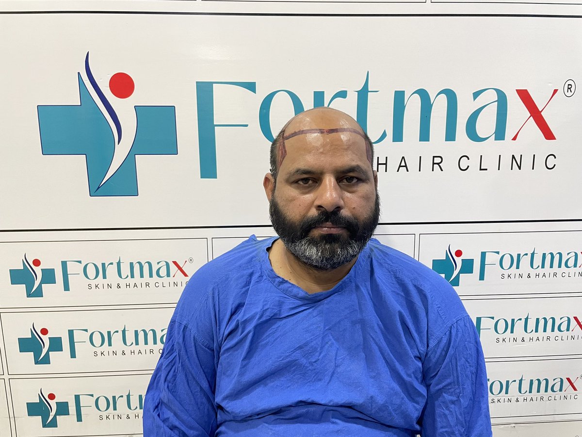 fortmaxclinic's tweet photo. #FortMaxClinic #HairTransplant #HairRestoration #HairLossSolution #ConfidenceBoost #EMIOffer #HairRevival #NewYou #HairTransformation #SelfAssurance #HairCare #BeConfident #HairGoals #ModernSolutions #HairTransplantdoctor #HairTreatment #Hairfall #Hairgrowth #Hairsolution https://t.co/QWzPW6L7u0