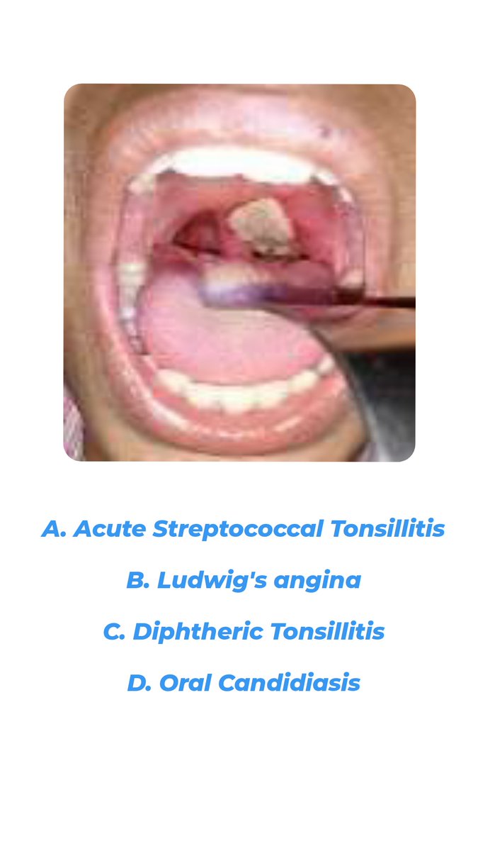 ⚕️A patient with features of sore throat, fever, cervical lymphadenopathy and oropharyngeal picture given in the image. What is the possible diagnosis?🔎

#MedTwitter #MedEd #MedX #ENT #Medicine #FMGE #NEETPG @fxgodzeuss @Farmanofficial_