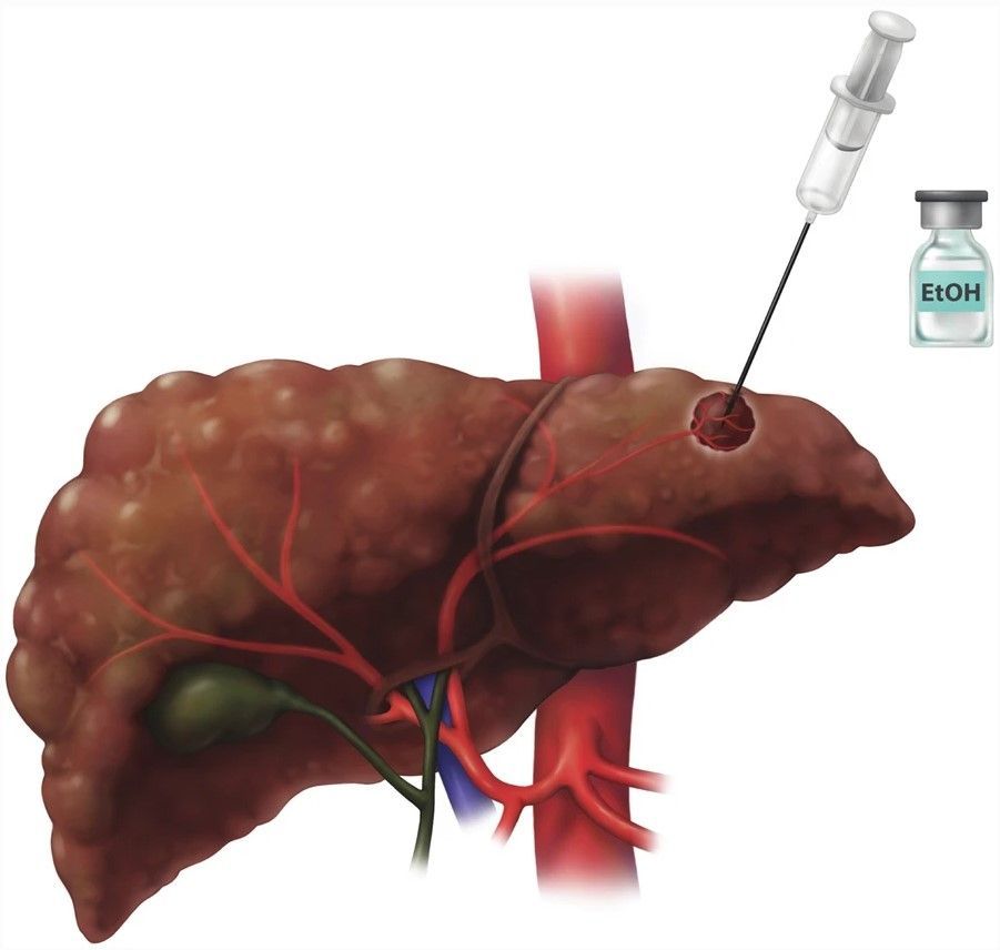 Educational Review: Assessment of hepatocellular carcinoma treatment response with #LIRADS. (Nicolas Voizard et al., @kielar_ania, @DrRichardDo, @Duotango, @LIRADS5)

#InsightsIntoImaging

🔗 buff.ly/3Uzrxtm