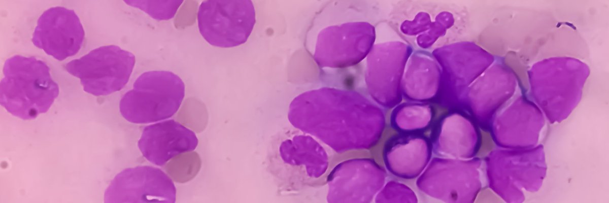 Exciting findings from @AjHematology: #Bleeding self-assessment aligns with trained staff evaluations in immune #thrombocytopenia. Dive into the latest #research here: buff.ly/3UFLHSx #MedTwitter #SoMeDocs #DocMatter
