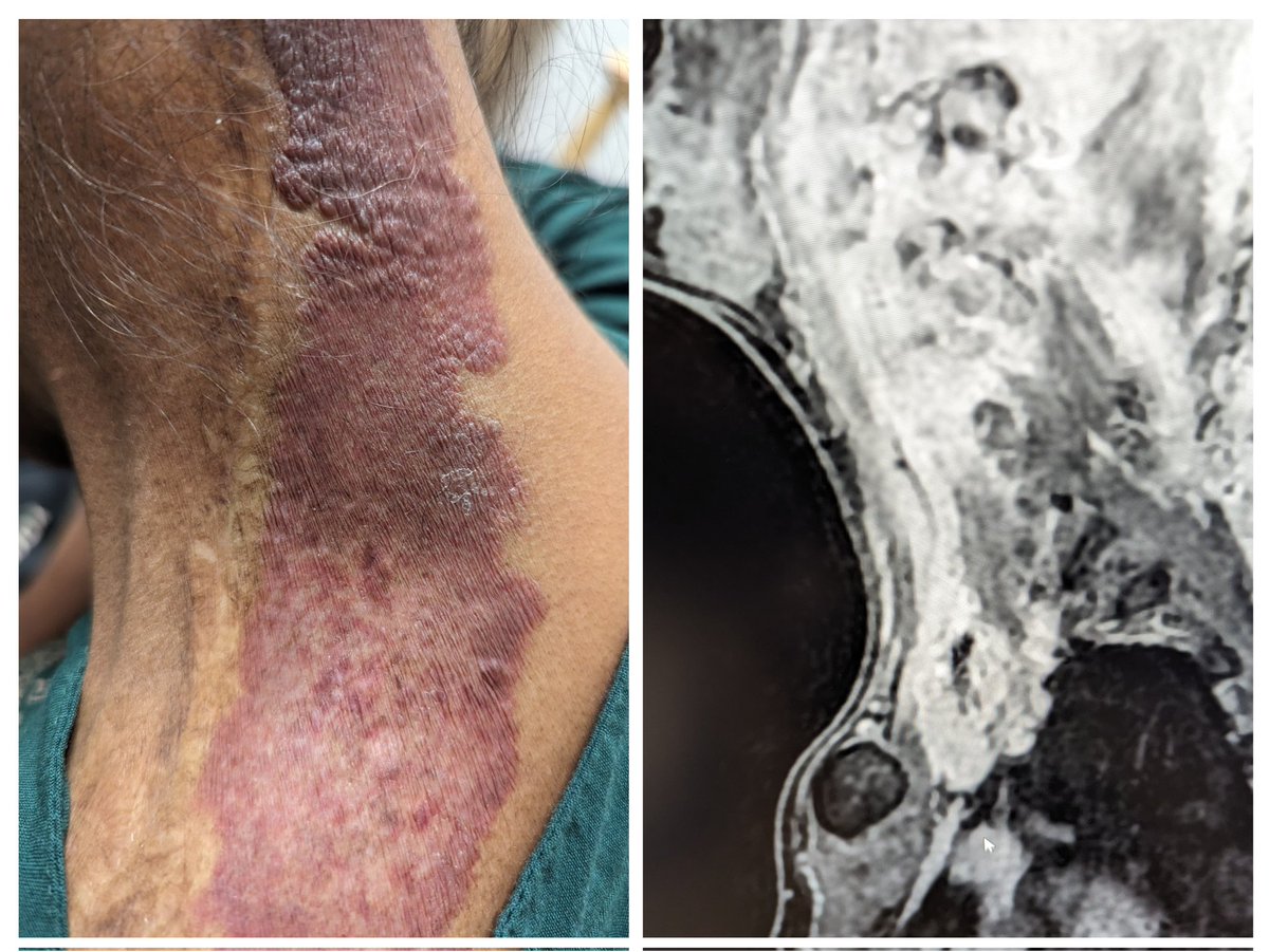 25 yr old lady with a strawberry nevus  nape of neck;underwent repeated surgeries for painful swellings in the neck in the past 5 years.Has severe pain radiating from the root of the neck to the upper limb.
Your diagnosis?
How would you manage ?
#medtwitter 
#radtwitter