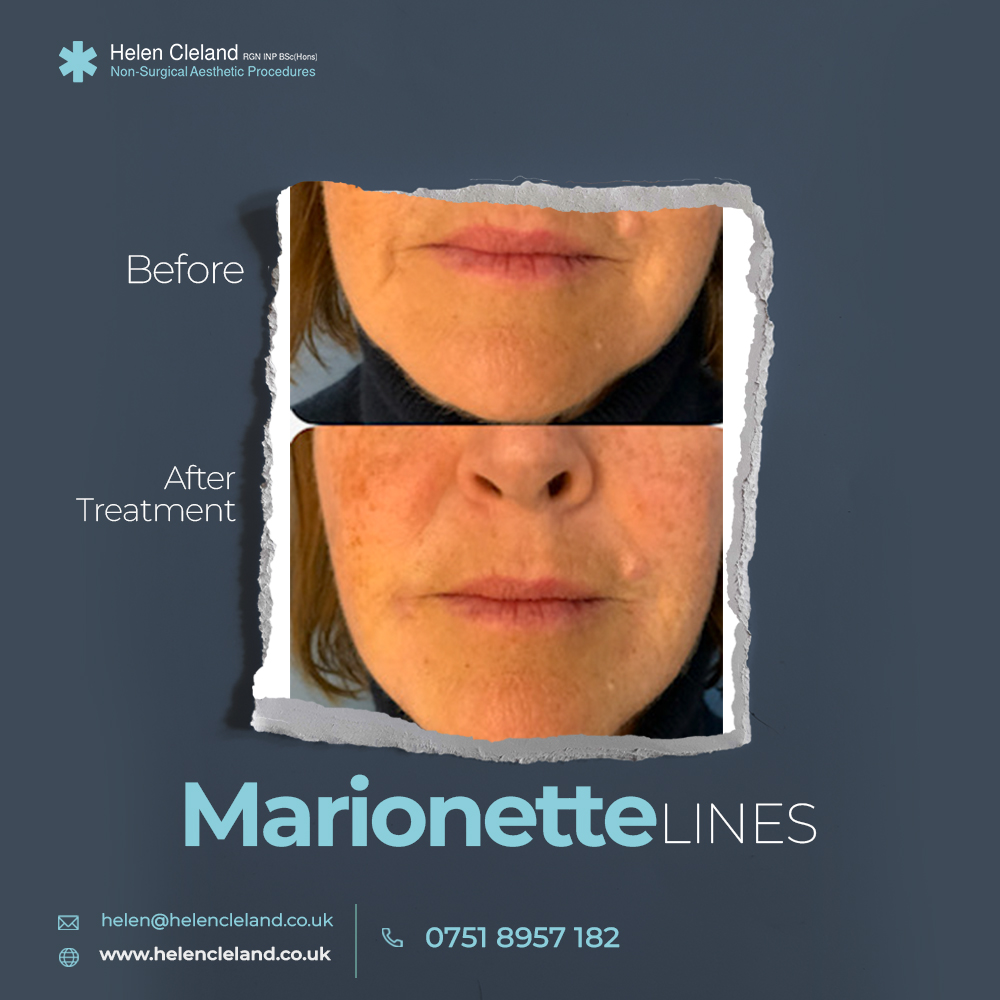 Are you looking to enhance your appearance and flaunt your face with a youthful and lifted appearance? Your search ends here. Get in touch with usour medical professionals are well-equipped to remove Marionette lines. Call us at the number 0751 8957182
#NonSurgical