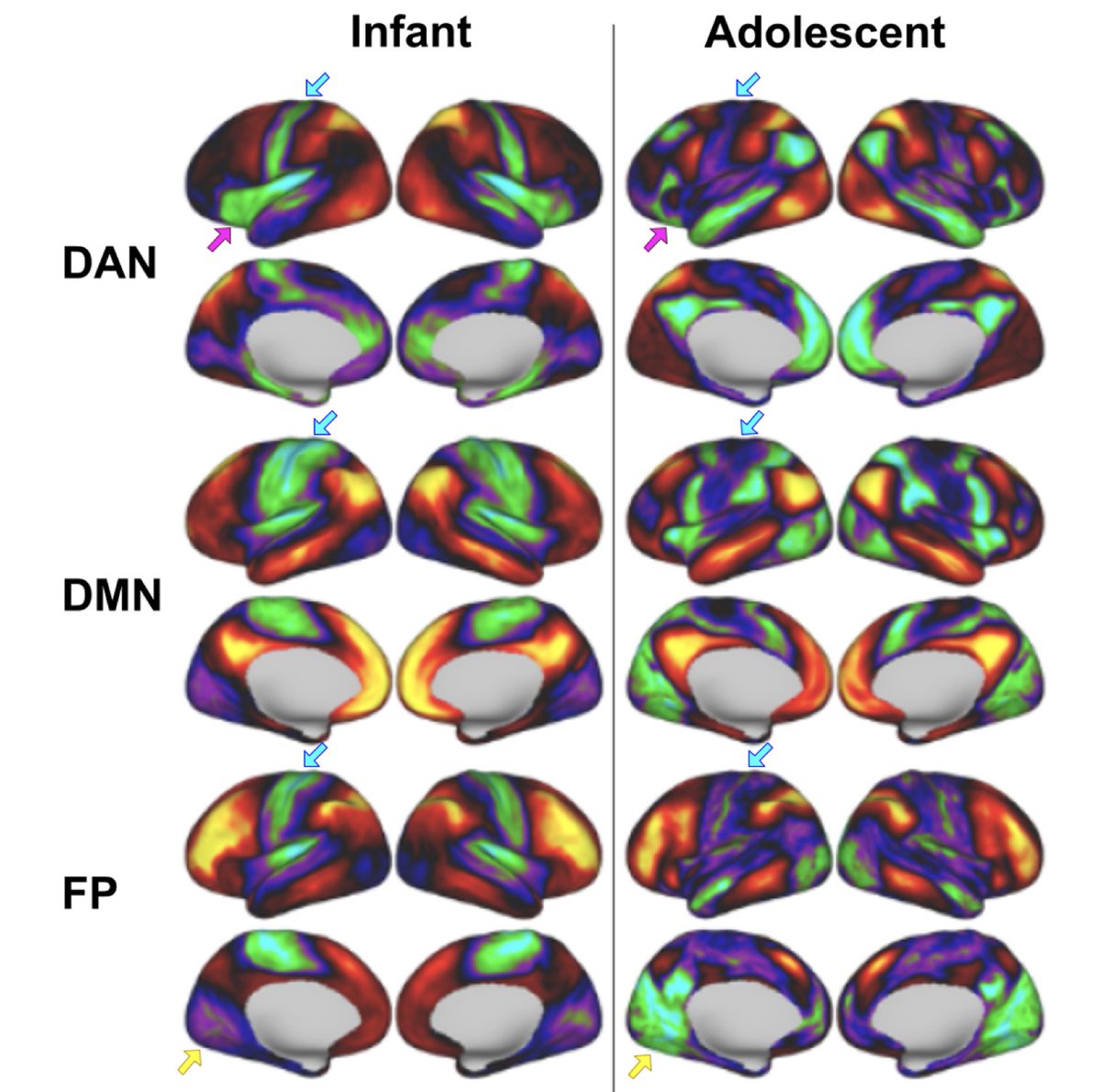 New paper in Imaging Neuroscience by Lucille A. Moore, Alice M. Graham, et al:

Towards personalized precision functional mapping in infancy

doi.org/10.1162/imag_a…