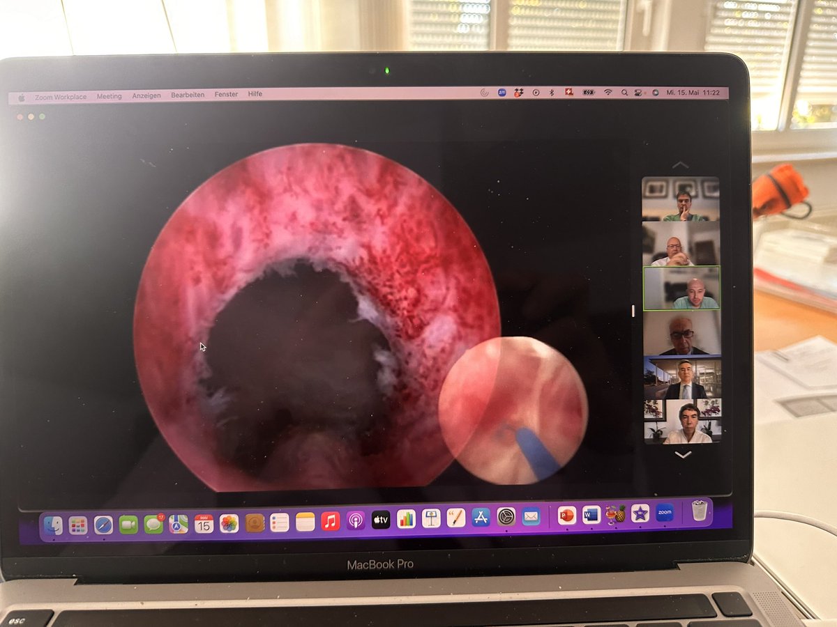 Thomas RW Herrmann (@trwherrmann) on Twitter photo Nice depicting of apical urethra rather than apical mucosa sparing. by cutting the mucosa we also preserve the underlying structures such as #lisso #sphincter. #Urethrasparing <a href="/SIU_urology/">SIU-Urology</a> #BPO update Wojciech Krajewski Nice depicting of apical urethra rather than apical mucosa sparing. by cutting the mucosa we also preserve the underlying structures such as #lisso #sphincter. #Urethrasparing <a href="/SIU_urology/">SIU-Urology</a> #BPO update Wojciech Krajewski