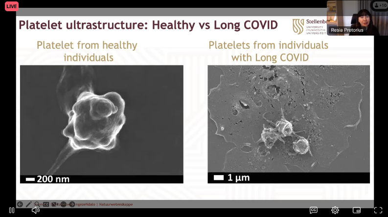 Platelet from healthy individuals vs platelets from individuals with #LongCovid #UniteToFight2024 / @resiapretorius