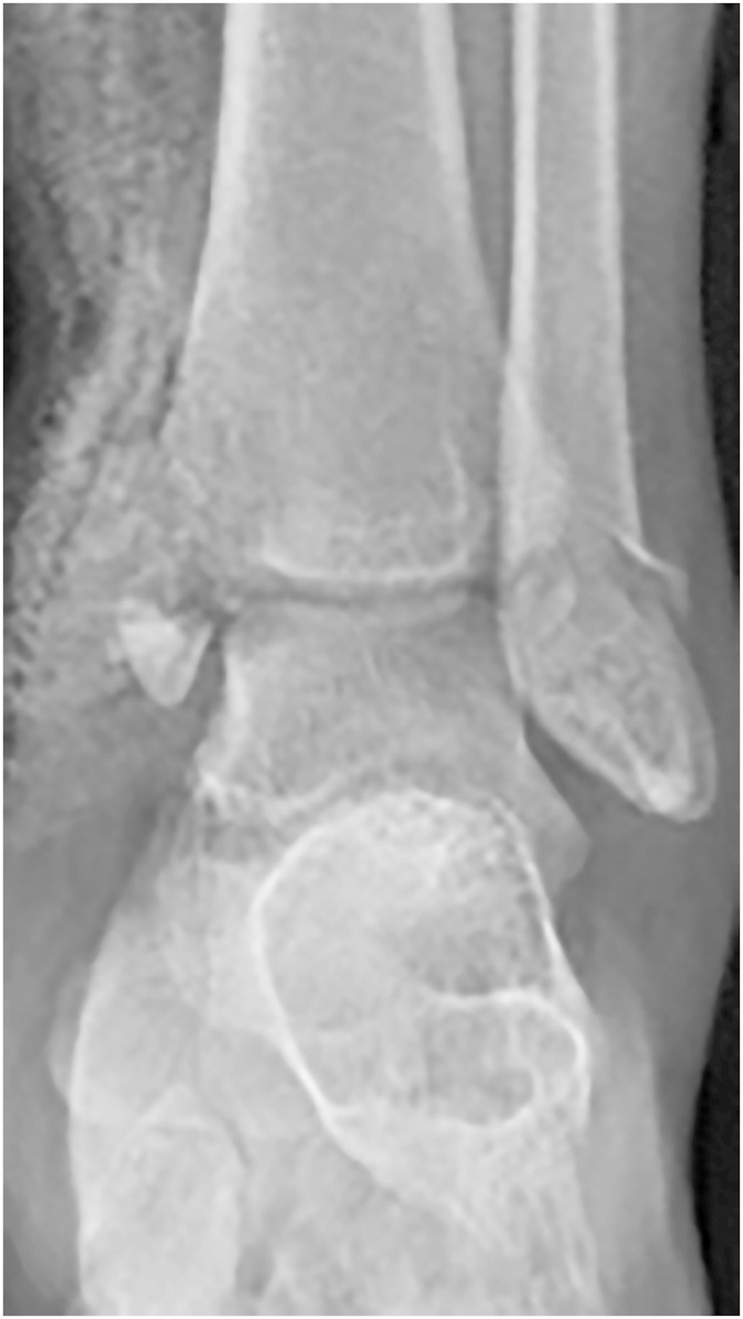 Reconstruction of the Medial Malleolus With Iliac Crest Autograft After Traumatic Loss #trauma #footankle bit.ly/4dB7nYW