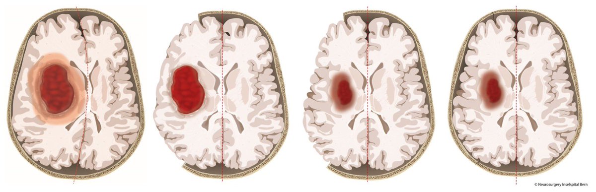 Uniklinik Freiburg (@uniklinik_fr) on Twitter photo Fortschritte in der Behandlung schwerer #Hirn-Blutungen! Eine von der <a href="/Uniklinik_Fr/">Uniklinik Freiburg</a> und der <a href="/StrokeBern/">Stroke Research Center Bern</a> geleitete internationale Studie gibt wichtige Hinweise darauf, dass ein neurochirurgischer Eingriff potenziell lebensrettend sein kann. In der #SWITCHStudie, publiziert in Fortschritte in der Behandlung schwerer #Hirn-Blutungen! Eine von der <a href="/Uniklinik_Fr/">Uniklinik Freiburg</a> und der <a href="/StrokeBern/">Stroke Research Center Bern</a> geleitete internationale Studie gibt wichtige Hinweise darauf, dass ein neurochirurgischer Eingriff potenziell lebensrettend sein kann. In der #SWITCHStudie, publiziert in