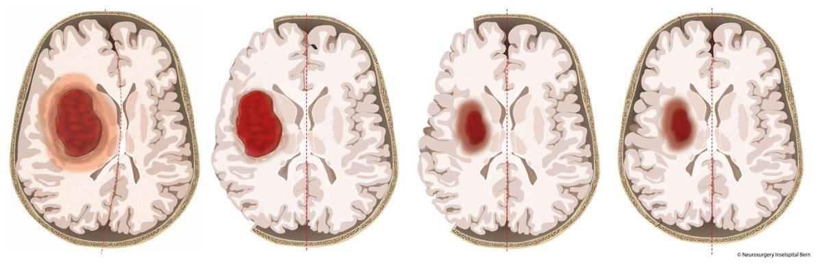 Fortschritte in der Behandlung schwerer #Hirn-Blutungen! Eine von der @Uniklinik_Fr und der @StrokeBern geleitete internationale Studie gibt wichtige Hinweise darauf, dass ein neurochirurgischer Eingriff potenziell lebensrettend sein kann. In der #SWITCHStudie, publiziert in