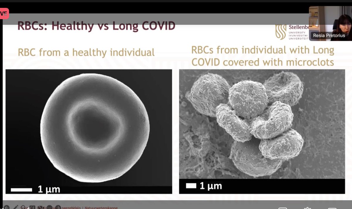 long_covid's tweet photo. More from #UniteToFight2024 with @resiapretorius, here showing the difference seen in red blood cells between a healthy person and red blood cells covered in microclots from a p/w #LongCovid.

#TreatLongCovid
#CureLongCovid https://t.co/sAMT9CbNvV