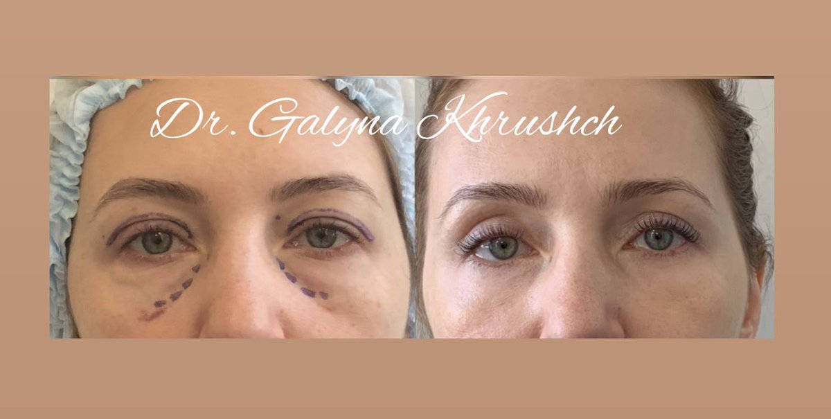 Blepharoplasty is one of my favorite surgeries. In this photo, you can see the results of an eyelid surgery I performed on a patient in Moscow, Russia, before I immigrated to the USA.#blepharoplastysurgery #drgalynakhrushch#dentalsurgery#orthognaticsurgery#rhinoplasty